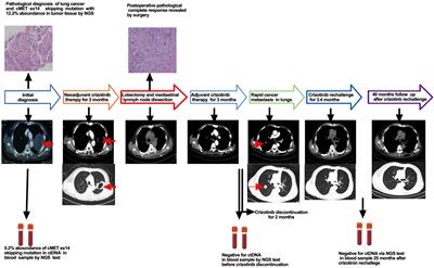 Complete pathological response and negative postoperative ctDNA were not predictive of discontinuation of adjuvant crizotinib therapy in a patient with locally advanced MET ex14 skipping mutation-positive non-small cell lung cancer: a case report